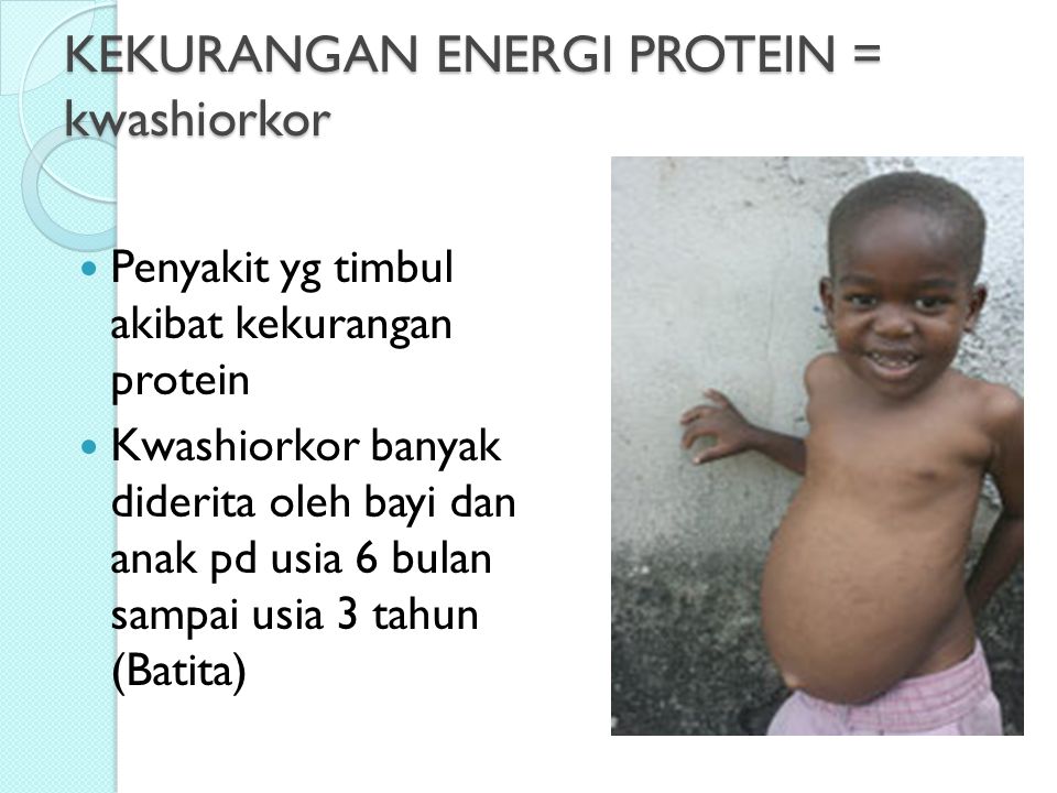 Detail Gambar Penyakit Kekurangan Protein Nomer 16