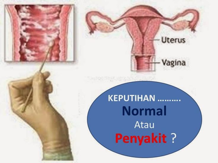 Gambar Penyakit Keputihan - KibrisPDR