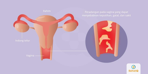 Detail Gambar Penyakit Keputihan Nomer 9