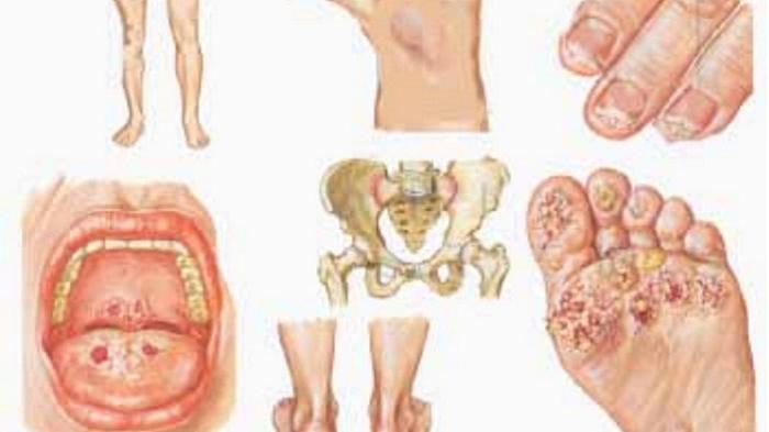 Detail Gambar Penyakit Klamidia Nomer 18