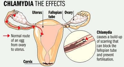 Detail Gambar Penyakit Klamidia Nomer 5