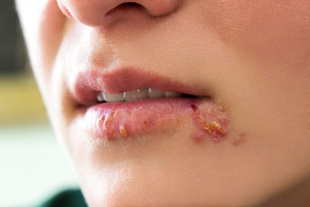 Detail Gambar Penyakit Kulit Herpes Nomer 19