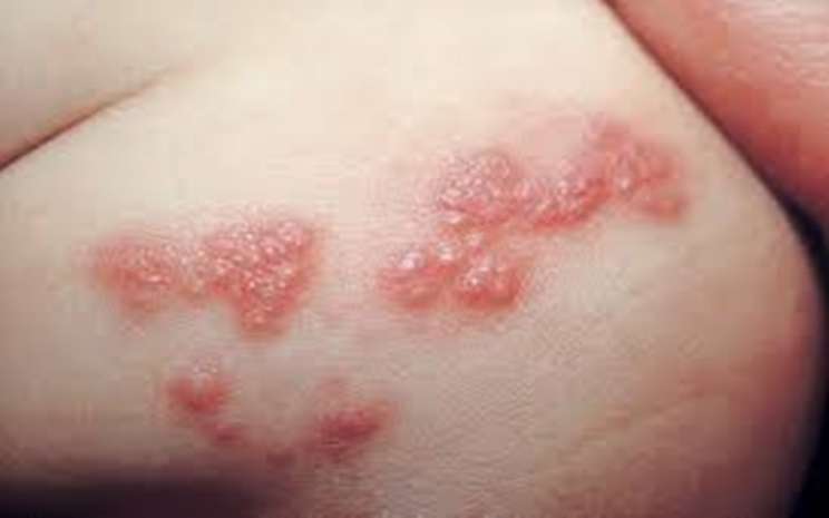 Detail Gambar Penyakit Kulit Herpes Nomer 2