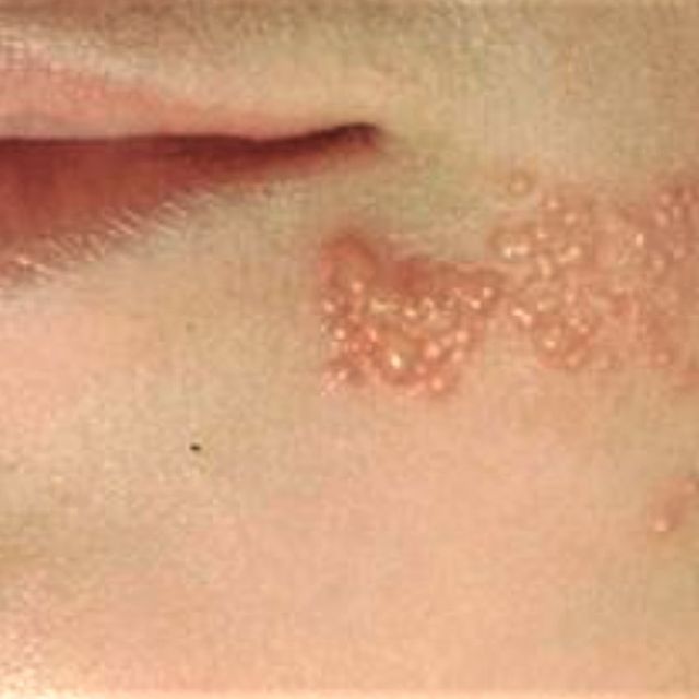 Detail Gambar Penyakit Kulit Herpes Nomer 23