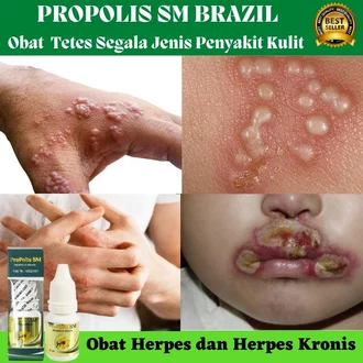 Detail Gambar Penyakit Kulit Herpes Nomer 24