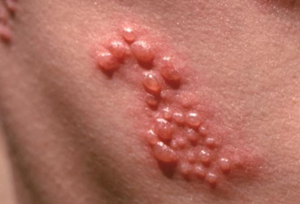 Detail Gambar Penyakit Kulit Herpes Nomer 25