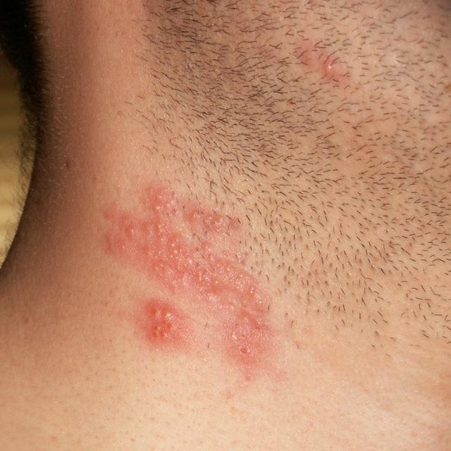 Detail Gambar Penyakit Kulit Herpes Nomer 3