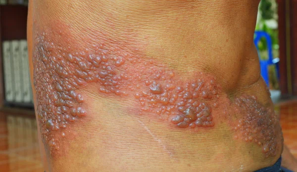Detail Gambar Penyakit Kulit Herpes Nomer 36