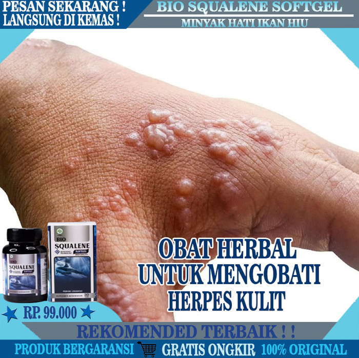 Detail Gambar Penyakit Kulit Herpes Nomer 49