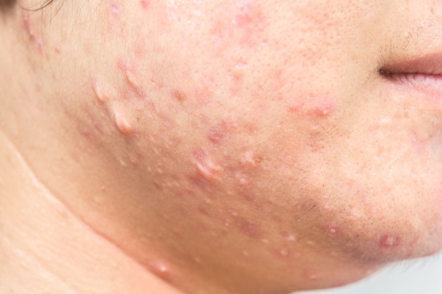 Detail Gambar Penyakit Kulit Herpes Nomer 50