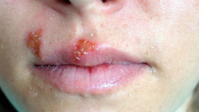 Detail Gambar Penyakit Kulit Herpes Nomer 6