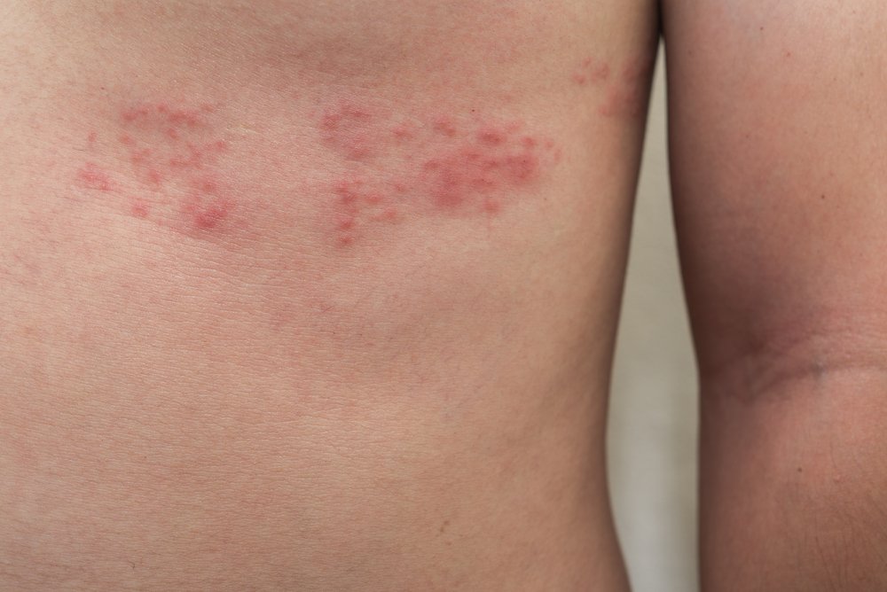 Detail Gambar Penyakit Kulit Herpes Nomer 7