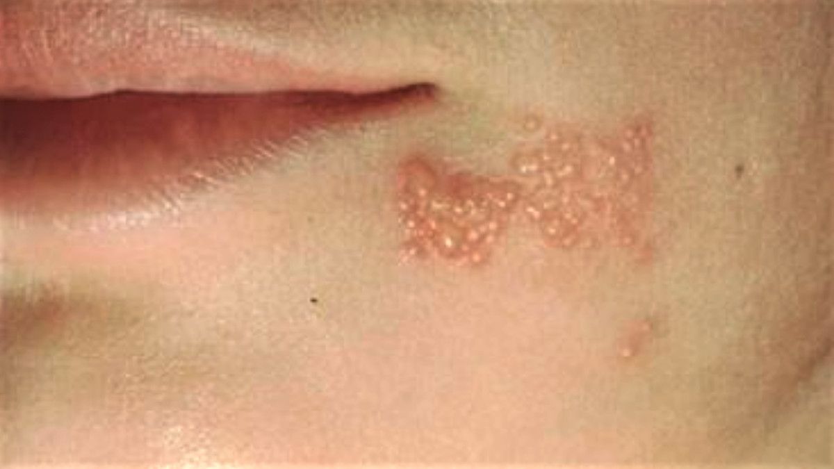 Gambar Penyakit Kulit Herpes Pada Wajah - KibrisPDR