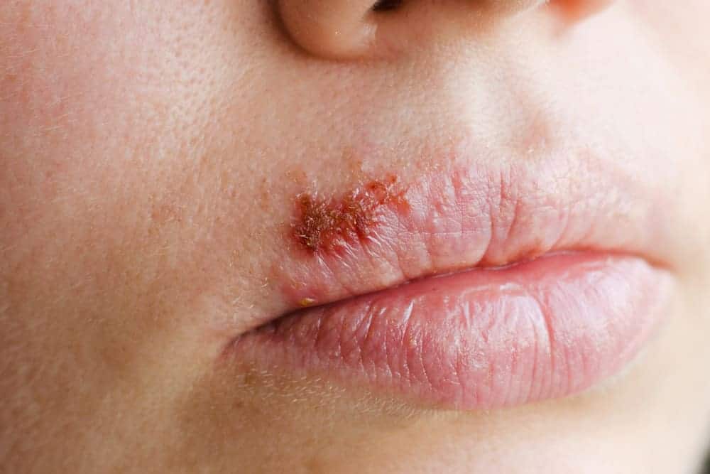 Detail Gambar Penyakit Kulit Herpes Pada Wajah Nomer 11