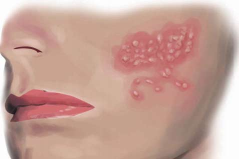 Detail Gambar Penyakit Kulit Herpes Pada Wajah Nomer 15