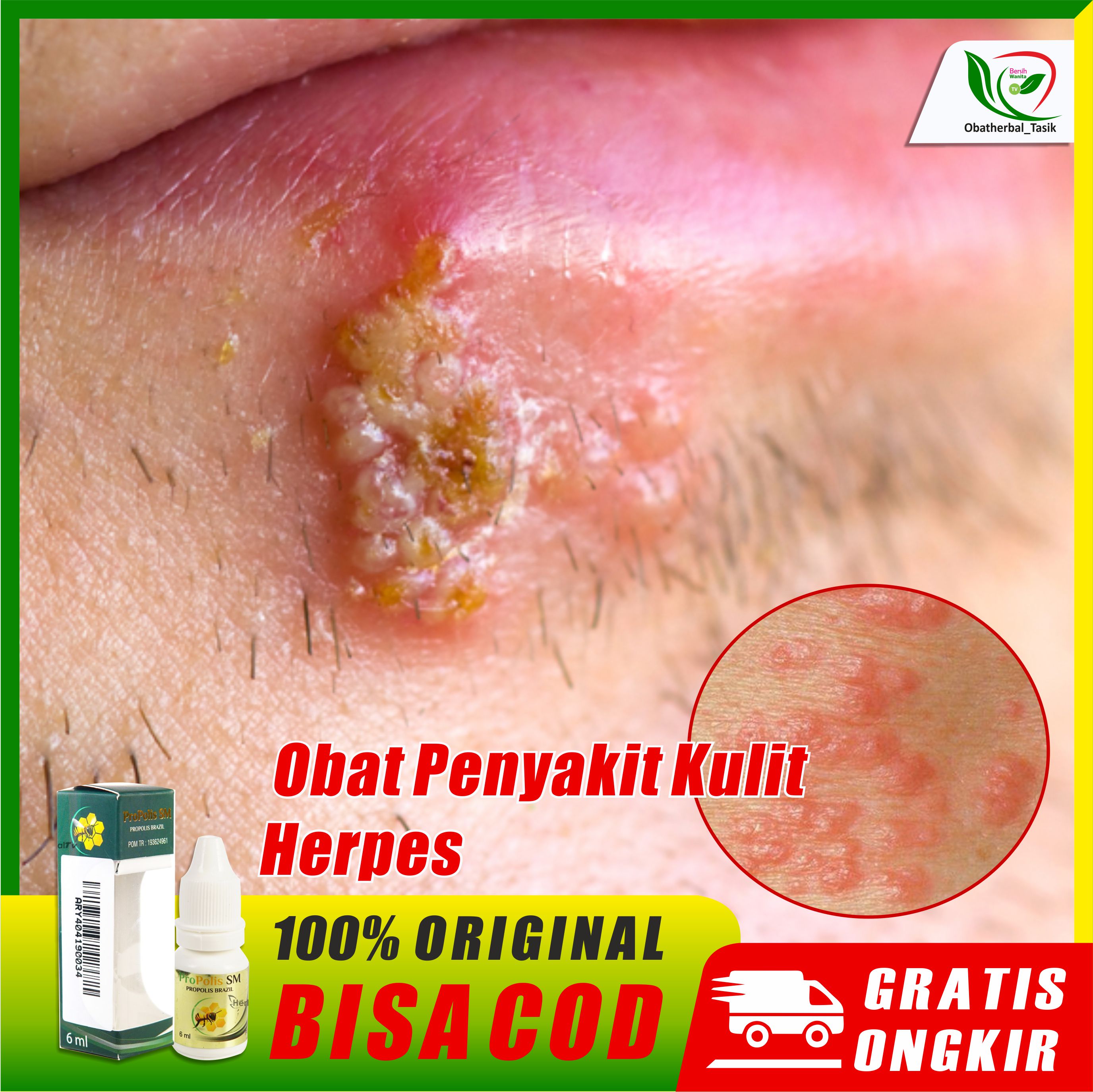 Detail Gambar Penyakit Kulit Herpes Pada Wajah Nomer 27