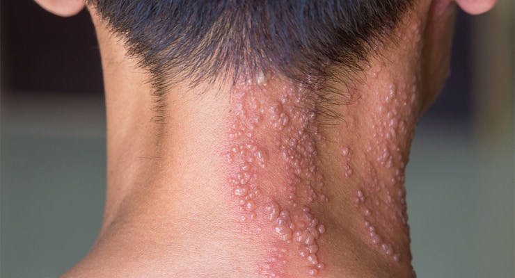 Detail Gambar Penyakit Kulit Herpes Pada Wajah Nomer 31