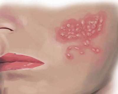 Detail Gambar Penyakit Kulit Herpes Pada Wajah Nomer 34