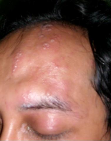 Detail Gambar Penyakit Kulit Herpes Pada Wajah Nomer 37