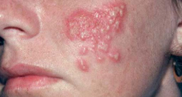 Detail Gambar Penyakit Kulit Herpes Pada Wajah Nomer 39