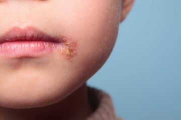 Detail Gambar Penyakit Kulit Herpes Pada Wajah Nomer 42