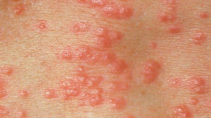 Detail Gambar Penyakit Kulit Herpes Pada Wajah Nomer 43