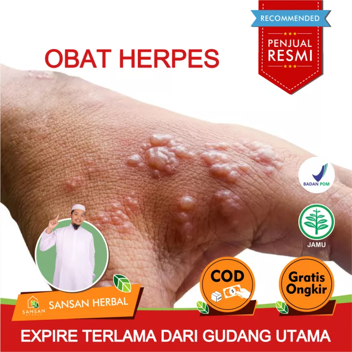 Detail Gambar Penyakit Kulit Herpes Pada Wajah Nomer 46