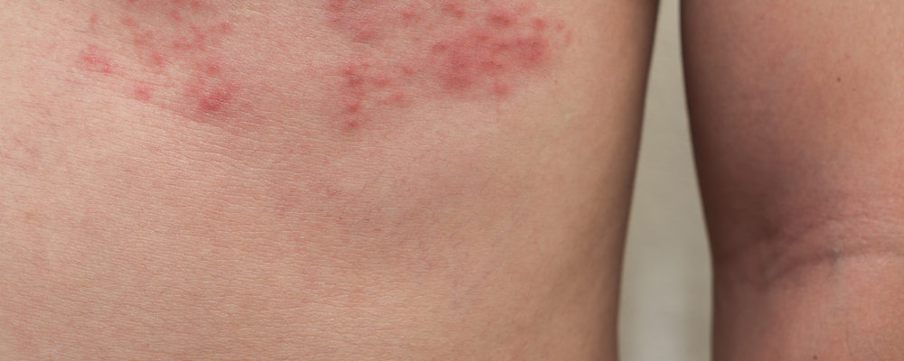 Detail Gambar Penyakit Kulit Herpes Pada Wajah Nomer 7