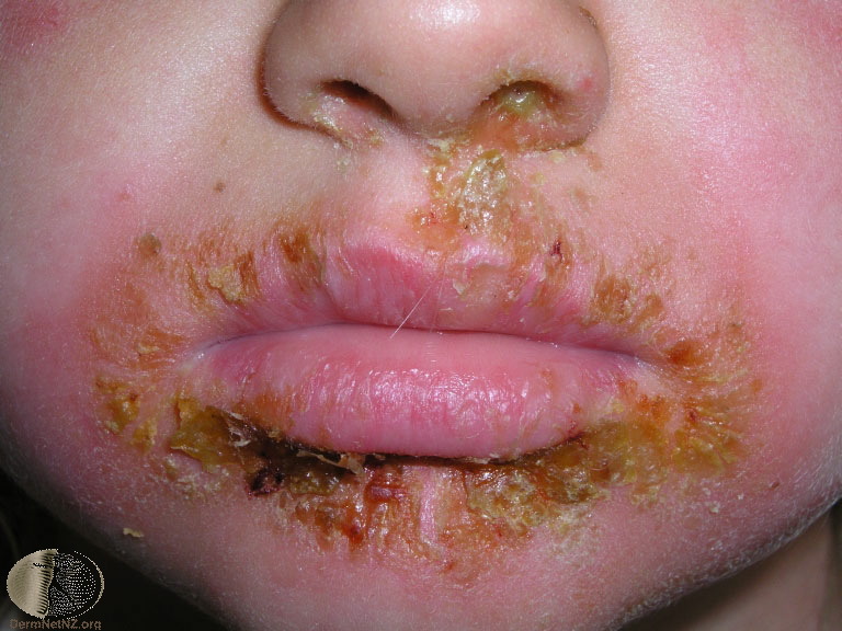 Detail Gambar Penyakit Kulit Herpes Pada Wajah Nomer 8