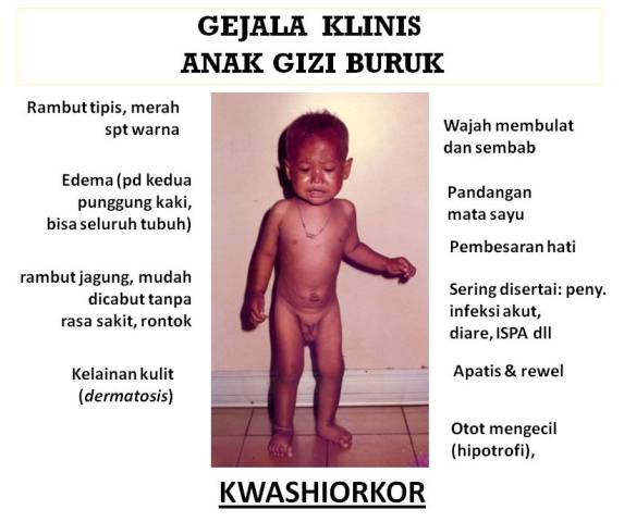 Detail Gambar Penyakit Kwashiorkor Nomer 12