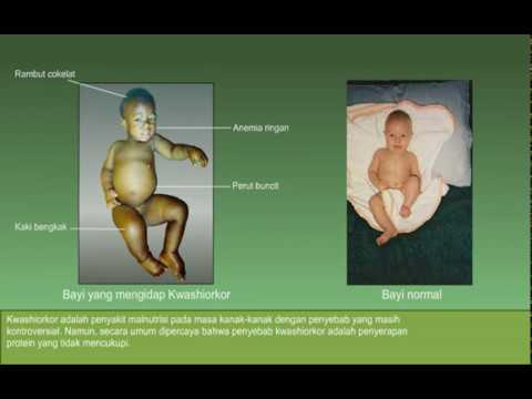 Detail Gambar Penyakit Kwashiorkor Nomer 24