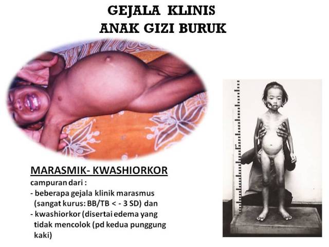 Detail Gambar Penyakit Kwashiorkor Nomer 31