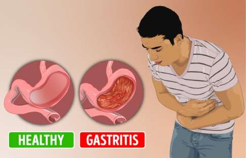 Detail Gambar Penyakit Lambung Nomer 7