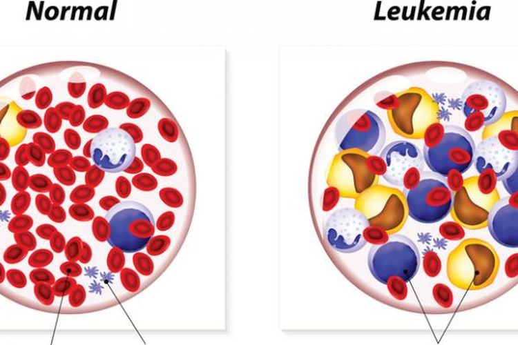 Detail Gambar Penyakit Leukemia Nomer 2