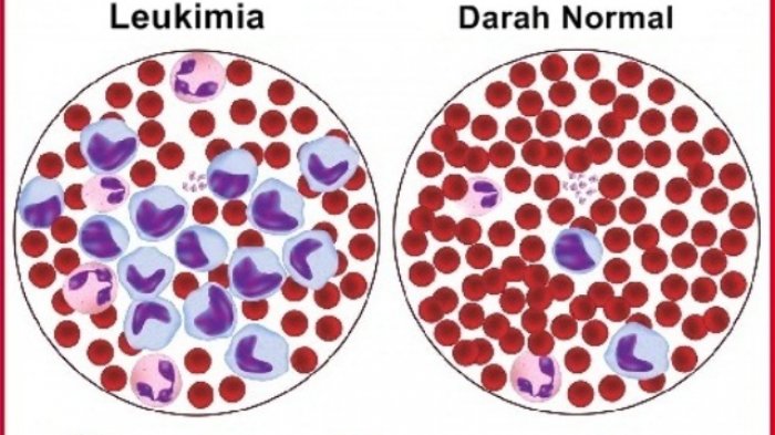 Detail Gambar Penyakit Leukemia Nomer 9