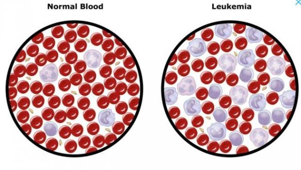 Detail Gambar Penyakit Leukemia Nomer 15