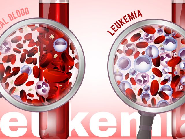 Detail Gambar Penyakit Leukemia Nomer 4