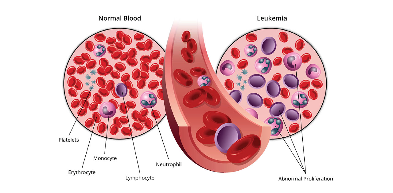 Detail Gambar Penyakit Leukemia Nomer 7