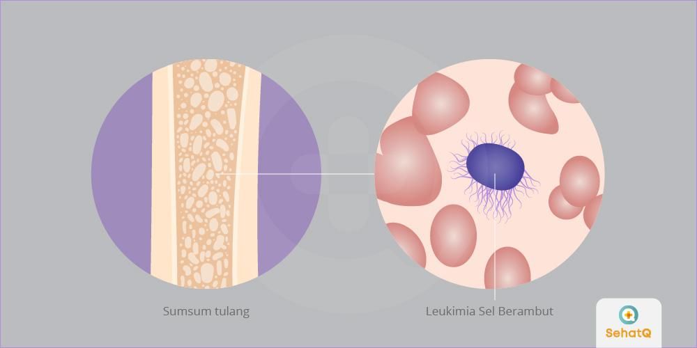 Detail Gambar Penyakit Leukimia Nomer 21