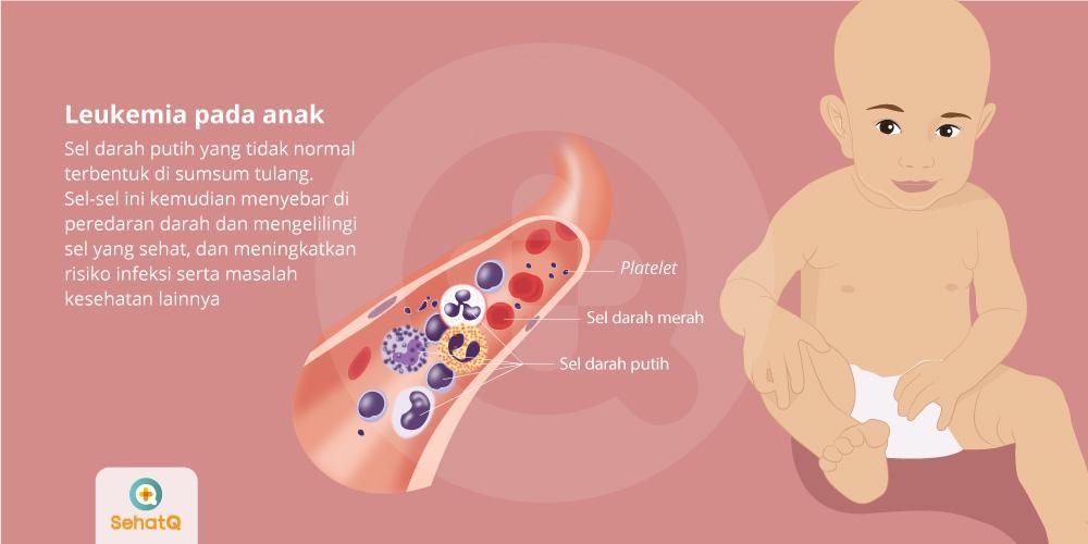 Detail Gambar Penyakit Leukimia Nomer 32