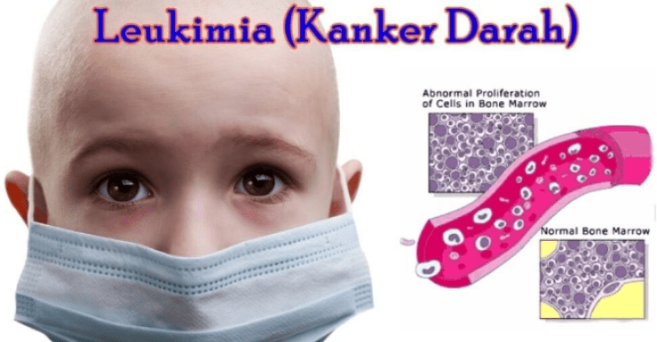 Detail Gambar Penyakit Leukimia Nomer 37