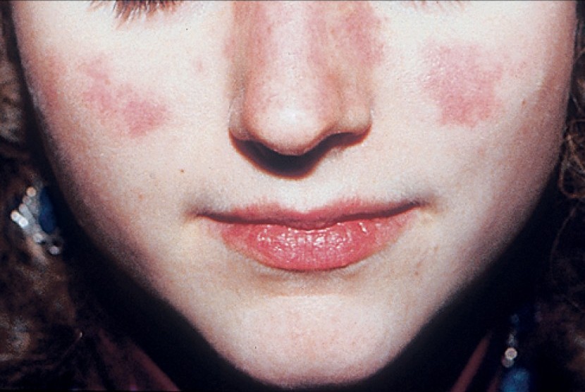 Detail Gambar Penyakit Lupus Nomer 10