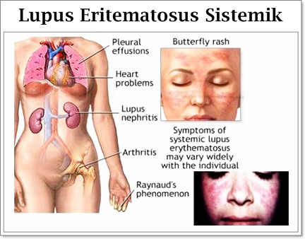 Detail Gambar Penyakit Lupus Nomer 23