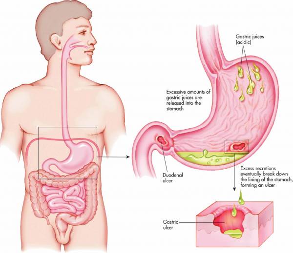 Gambar Penyakit Maag - KibrisPDR