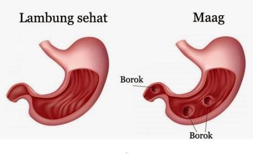 Detail Gambar Penyakit Maag Nomer 23