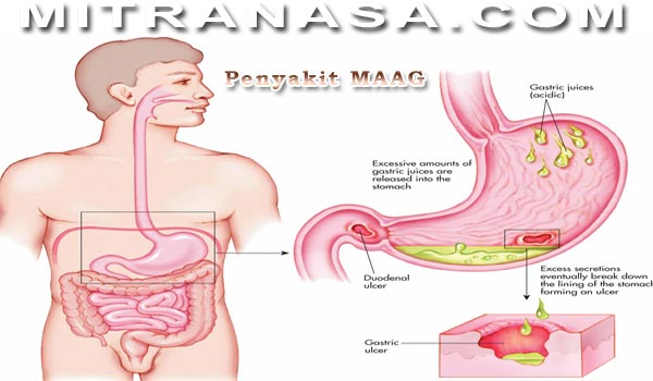 Detail Gambar Penyakit Maag Nomer 27