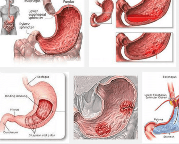 Detail Gambar Penyakit Maag Nomer 29