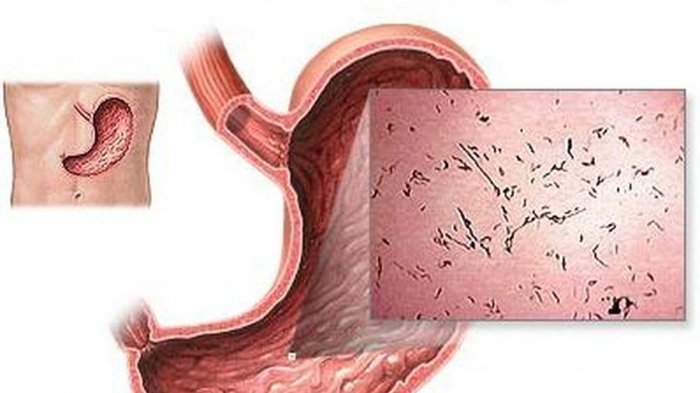 Detail Gambar Penyakit Maag Nomer 31