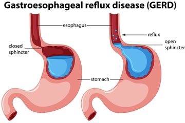 Detail Gambar Penyakit Maag Nomer 45
