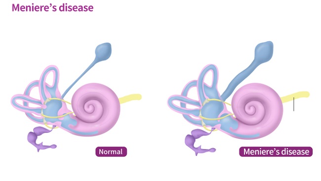 Detail Gambar Penyakit Meniere Nomer 2